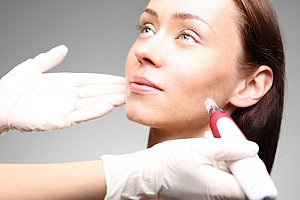 Jedno až tři ošetření tváře laserovou procedurou microneedling v salonu Sia Bello v Brně