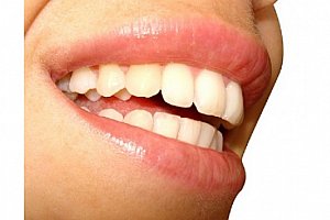 Neperoxidové bělení zubů