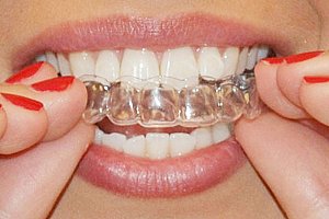 Formičky na bělení zubů - 2 kusy a poštovné ZDARMA!
