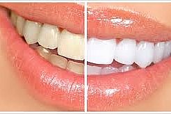 Neperoxidové bělení zubů v délce 40 min. Rozjasněte svůj úsměv!