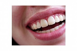 Neperoxidové bělení zubů