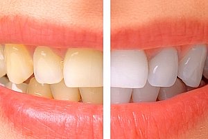 Bělení zubů, dentální hygiena nebo Air Flow v centru Prahy či Českých Budějovicích.