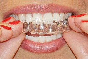Formička na bělení zubů CD48 a poštovné ZDARMA!